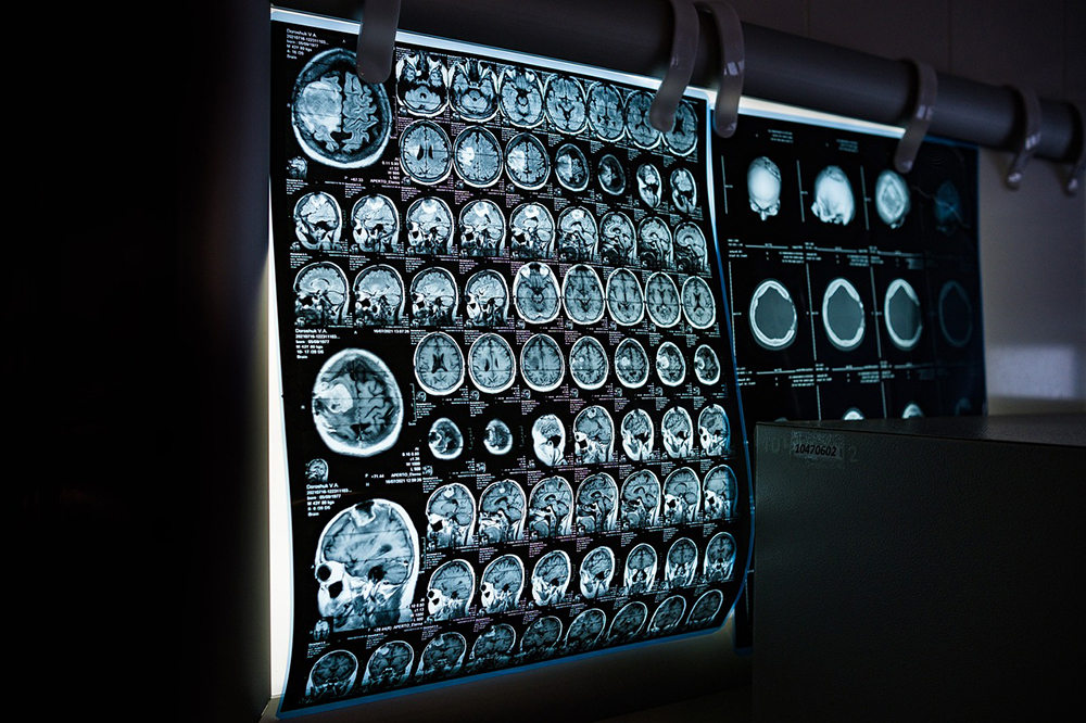 Can a Concussion Cause Permanent Brain Damage